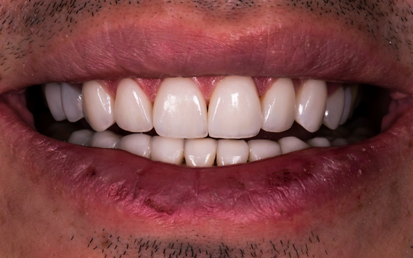 What Is Full Mouth Reconstruction?
